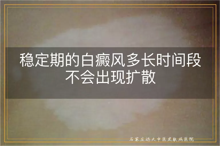 稳定期的白癜风多长时间段不会出现扩散
