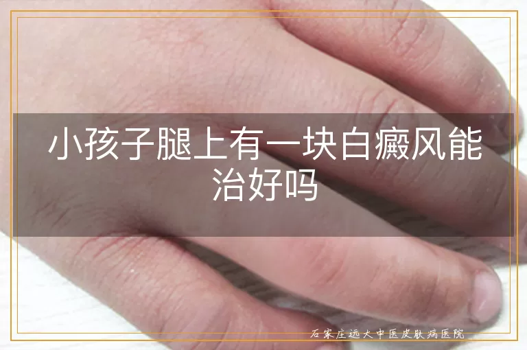 小孩子腿上有一块白癜风能治好吗