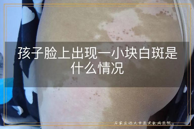 孩子脸上出现一小块白斑是什么情况