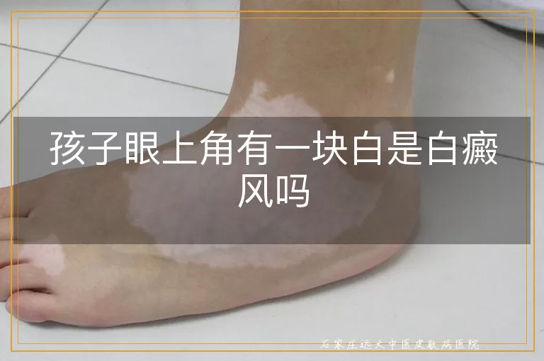 孩子眼上角有一块白是白癜风吗