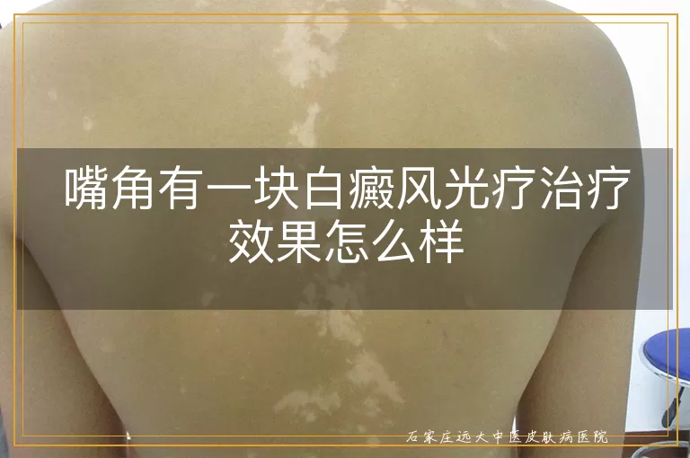 嘴角有一块白癜风光疗治疗效果怎么样