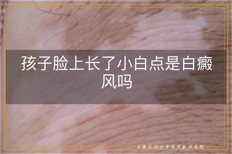 孩子脸上长了小白点是白癜风吗