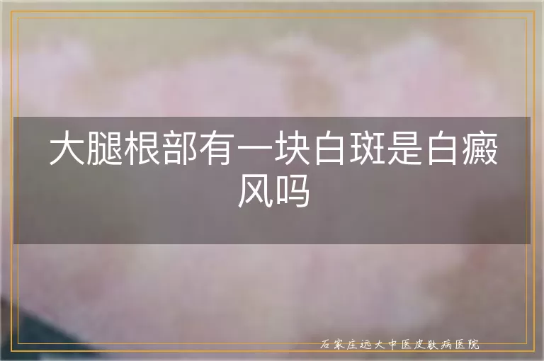大腿根部有一块白斑是白癜风吗