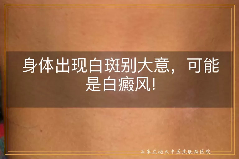 身体出现白斑别大意，可能是白癜风!