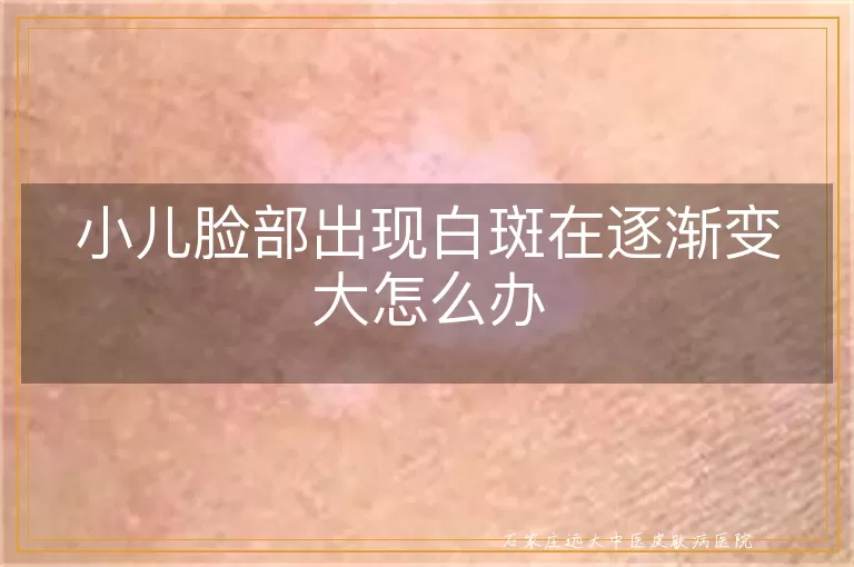 小儿脸部出现白斑在逐渐变大怎么办
