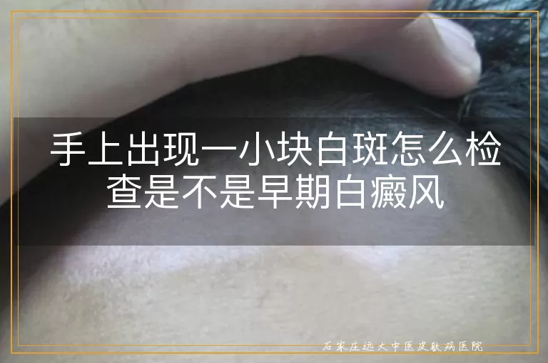 手上出现一小块白斑怎么检查是不是早期白癜风