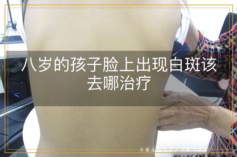 八岁的孩子脸上出现白斑该去哪治疗