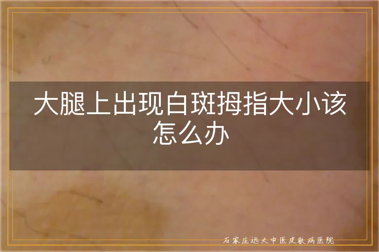 大腿上出现白斑拇指大小该怎么办
