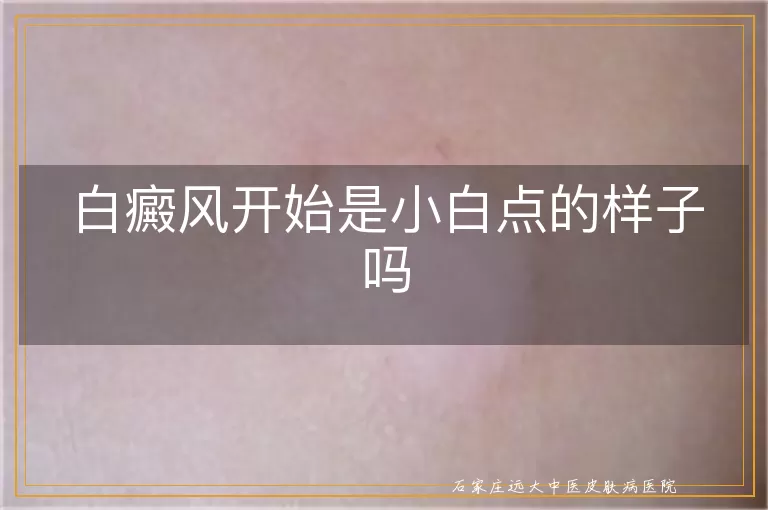 白癜风开始是小白点的样子吗