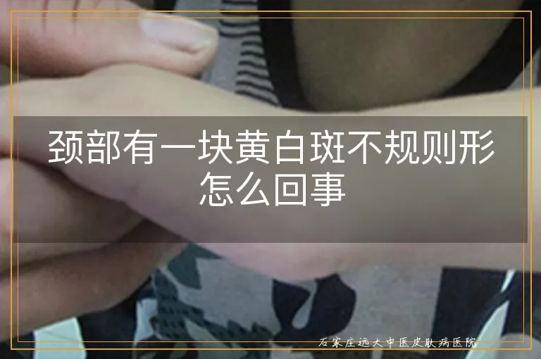 颈部有一块黄白斑不规则形怎么回事
