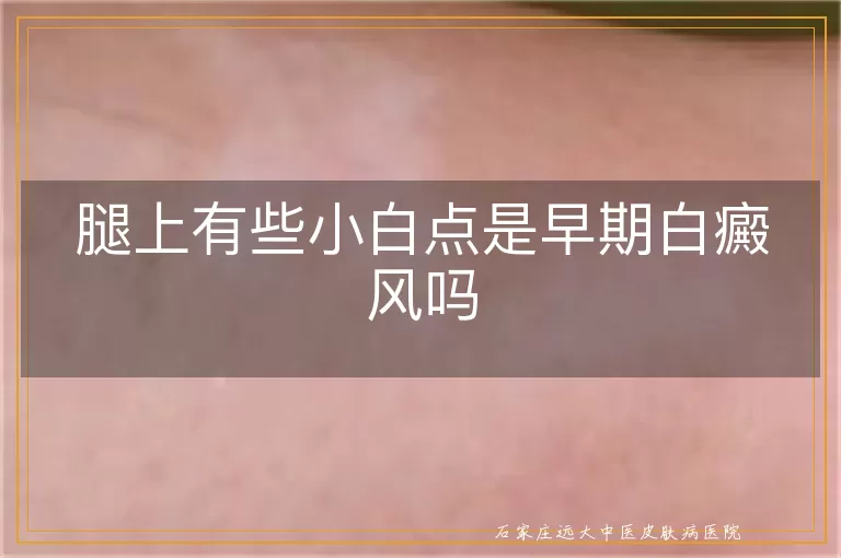 腿上有些小白点是早期白癜风吗