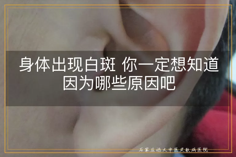 身体出现白斑 你一定想知道因为哪些原因吧