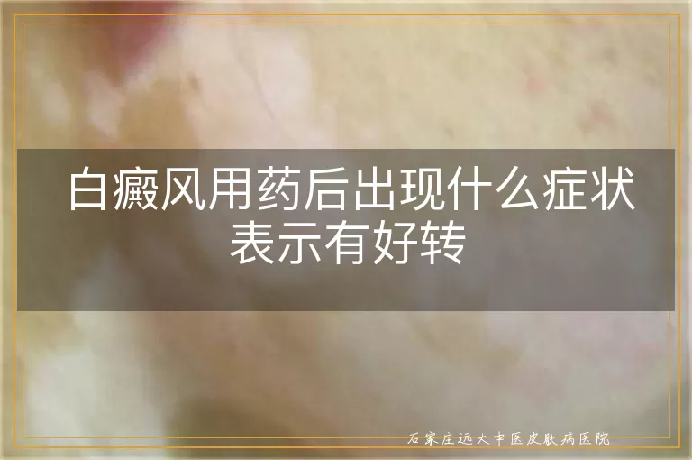 白癜风用药后出现什么症状表示有好转