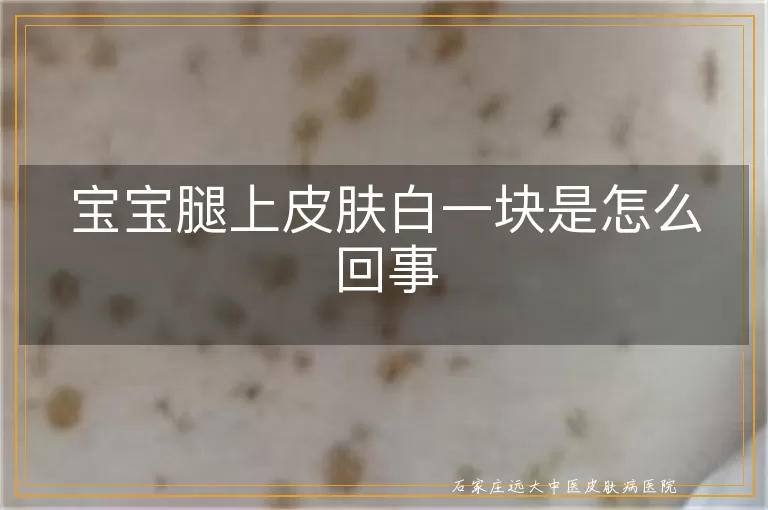 宝宝腿上皮肤白一块是怎么回事