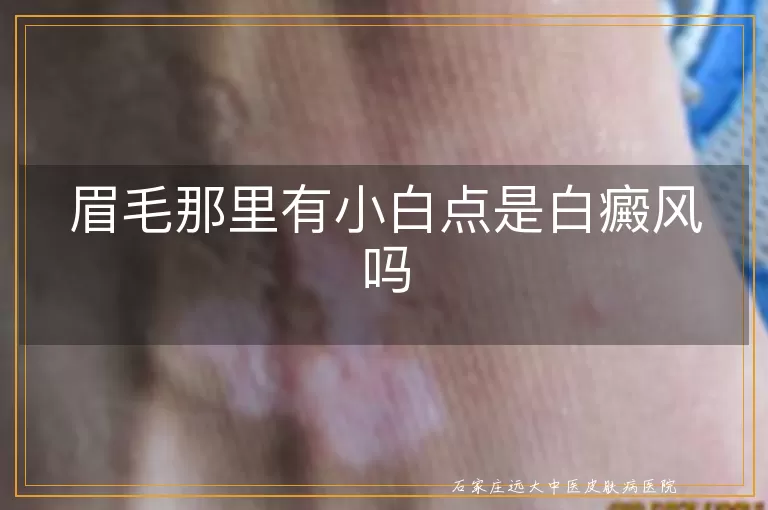 眉毛那里有小白点是白癜风吗