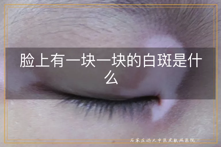 脸上有一块一块的白斑是什么