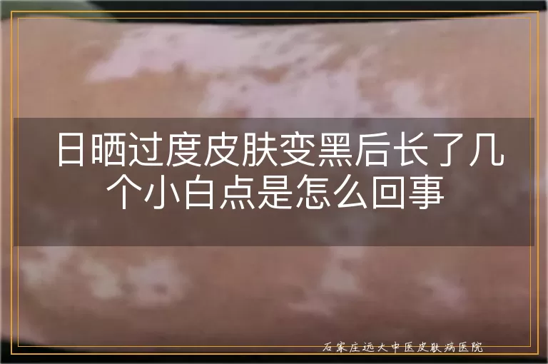 日晒过度皮肤变黑后长了几个小白点是怎么回事