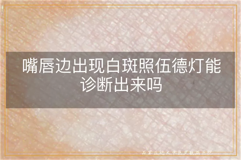嘴唇边出现白斑照伍德灯能诊断出来吗