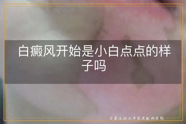 白癜风开始是小白点点的样子吗