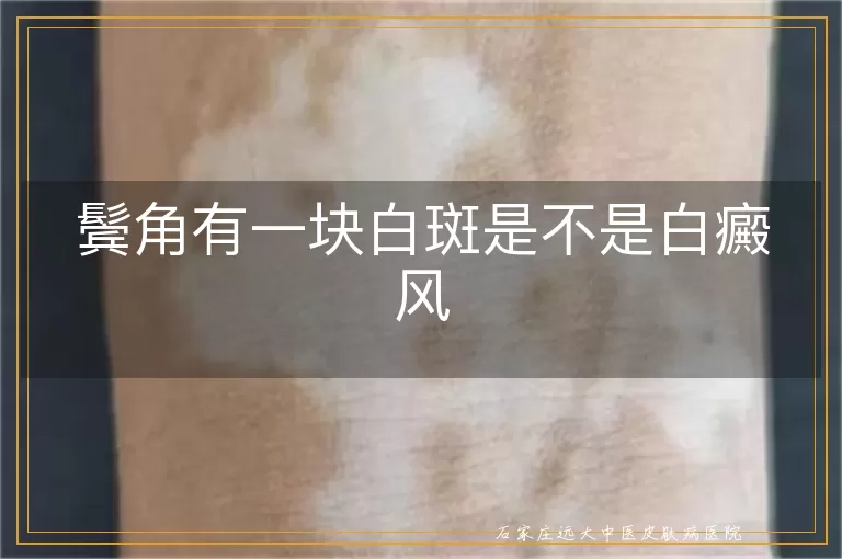 鬓角有一块白斑是不是白癜风