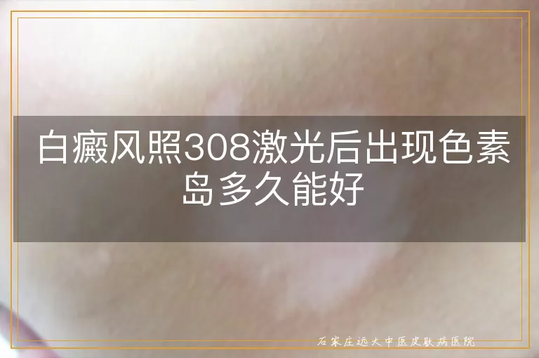 白癜风照308激光后出现色素岛多久能好