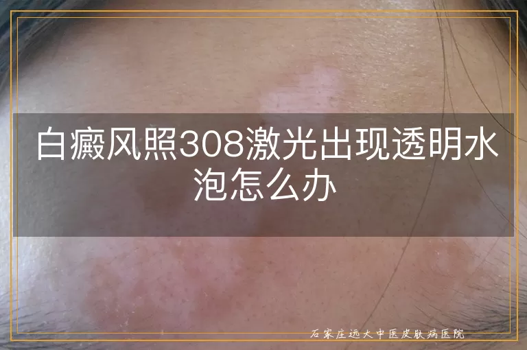 白癜风照308激光出现透明水泡怎么办