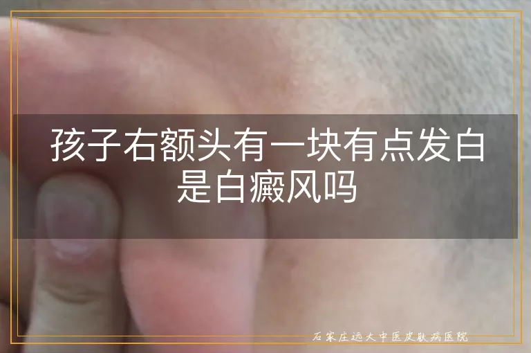 孩子右额头有一块有点发白是白癜风吗