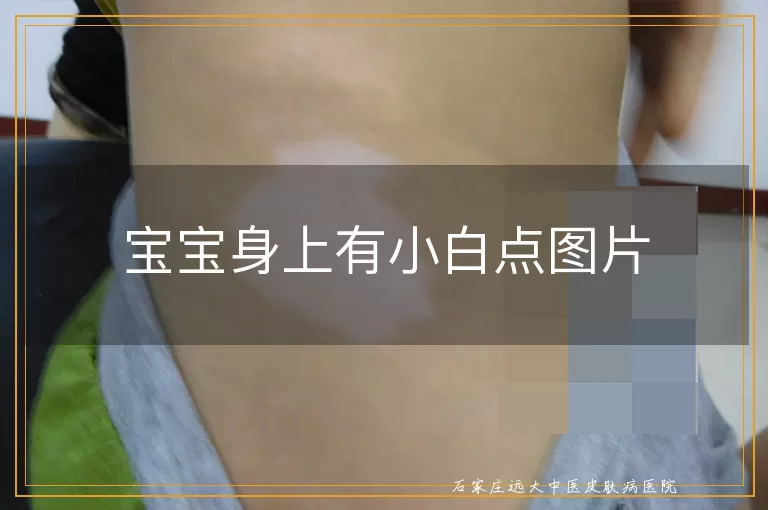 宝宝身上有小白点图片