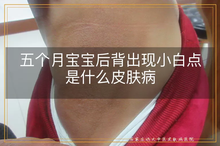 五个月宝宝后背出现小白点是什么皮肤病
