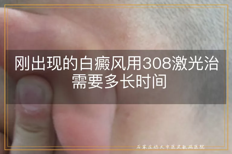 刚出现的白癜风用308激光治 需要多长时间