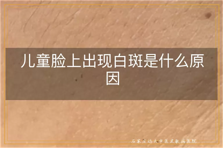 儿童脸上出现白斑是什么原因