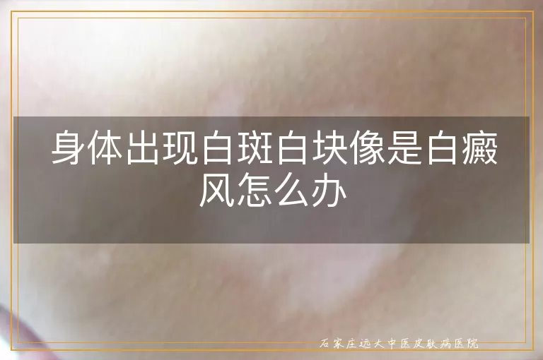 身体出现白斑白块像是白癜风怎么办