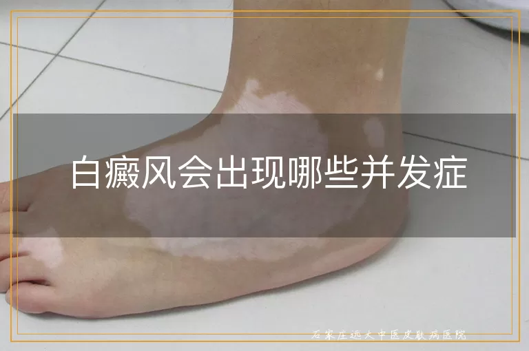 白癜风会出现哪些并发症
