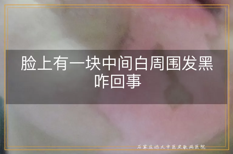 脸上有一块中间白周围发黑咋回事