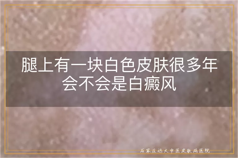 腿上有一块白色皮肤很多年会不会是白癜风