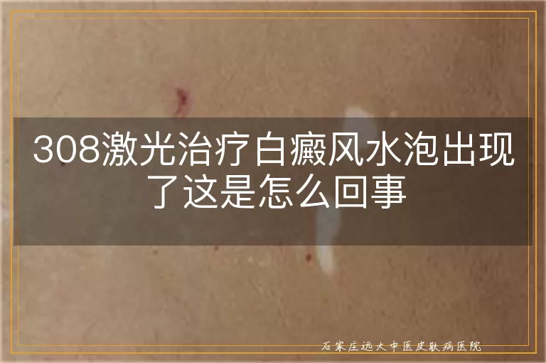308激光治疗白癜风水泡出现了这是怎么回事