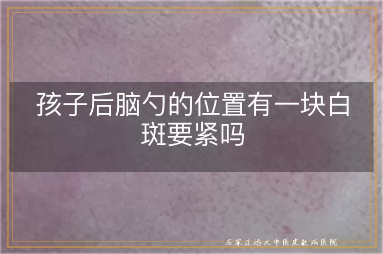 孩子后脑勺的位置有一块白斑要紧吗