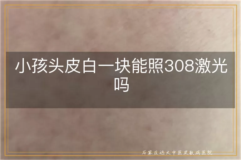 小孩头皮白一块能照308激光吗