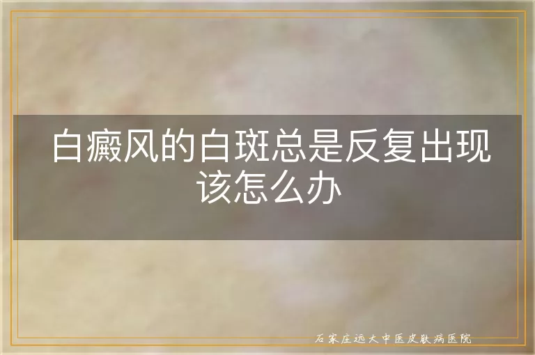 白癜风的白斑总是反复出现该怎么办