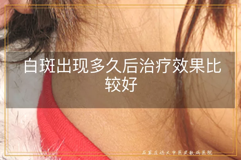 白斑出现多久后治疗效果比较好