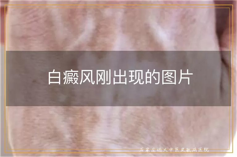 白癜风刚出现的图片