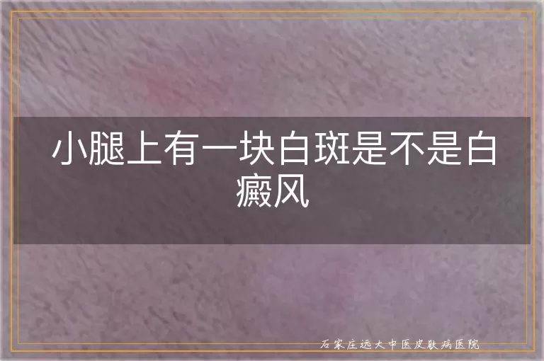 小腿上有一块白斑是不是白癜风