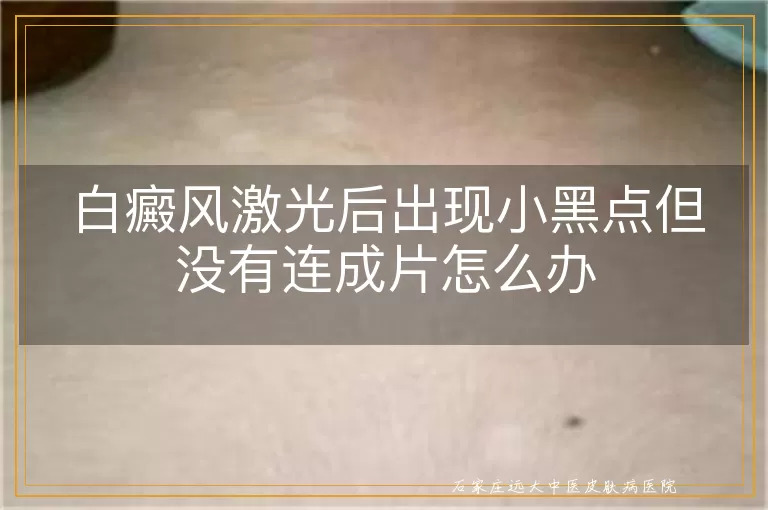 白癜风激光后出现小黑点但没有连成片怎么办