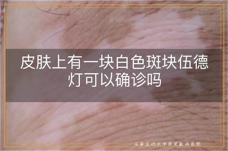 皮肤上有一块白色斑块伍德灯可以确诊吗