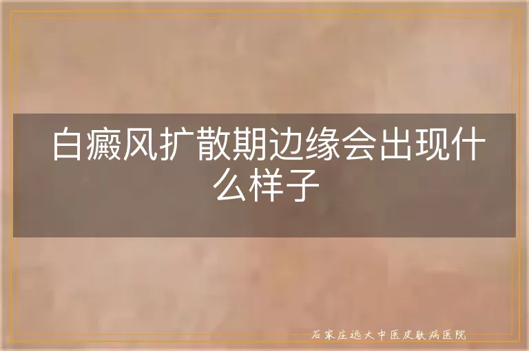 白癜风扩散期边缘会出现什么样子