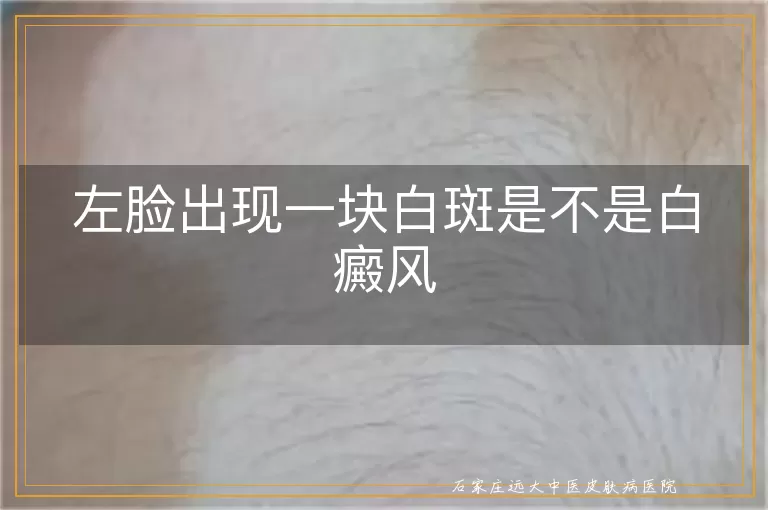 左脸出现一块白斑是不是白癜风