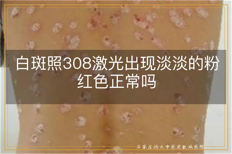 白斑照308激光出现淡淡的粉红色正常吗