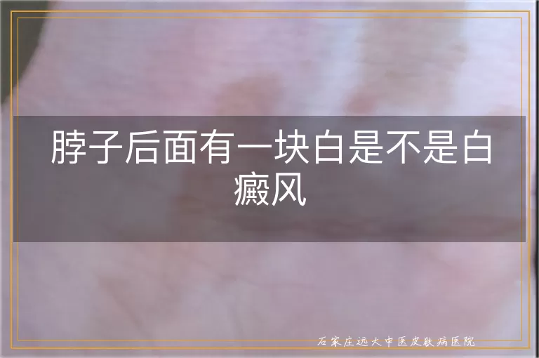 脖子后面有一块白是不是白癜风