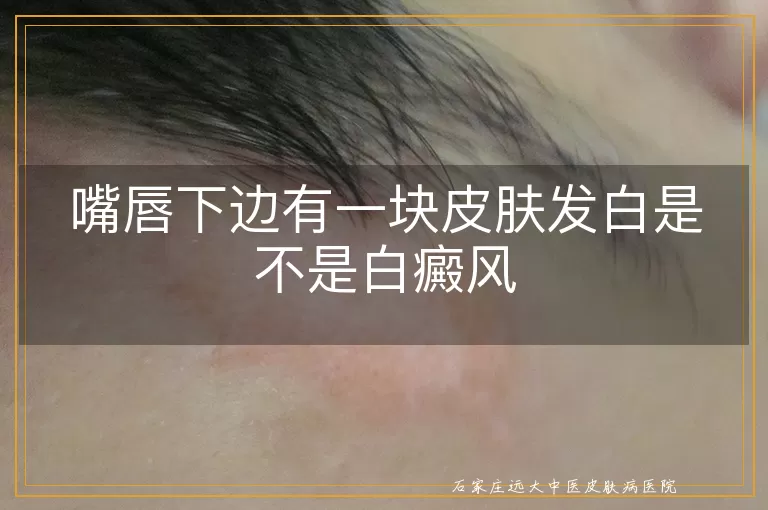 嘴唇下边有一块皮肤发白是不是白癜风