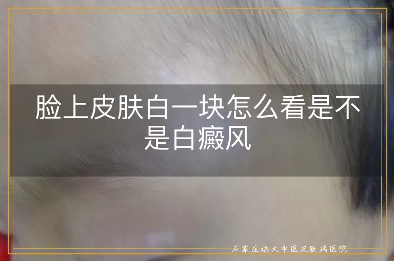 脸上皮肤白一块怎么看是不是白癜风